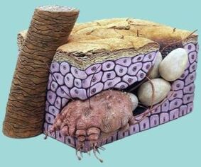 Schurftmijt, die zich manifesteert als jeuk aan de huid, soms in de vorm van vlekken en roodheid